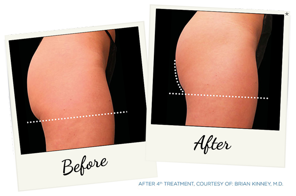 Why is BTL EMSCULPT® the Breakthrough in Body Shaping?
