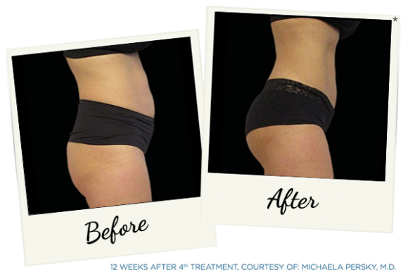Before & After Pictures by Emsculpt® Providers - Burn Fat & Build Muscle